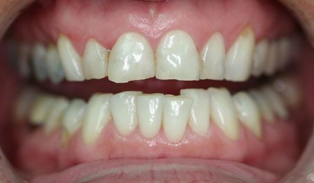 crooked teeth before photo